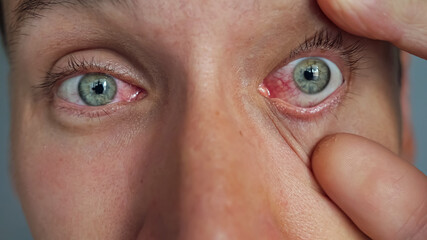 man rubs red sore eyes with hands.