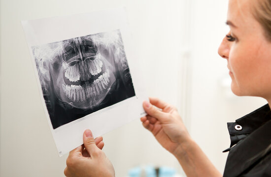 x-ray of a full jaw close up in the hands of a white female doctor