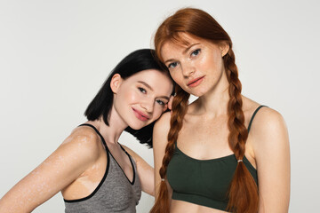 Smiling sportswoman with vitiligo standing near freckled friend isolated on grey