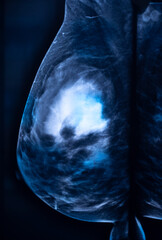 Breast mamogram xray test