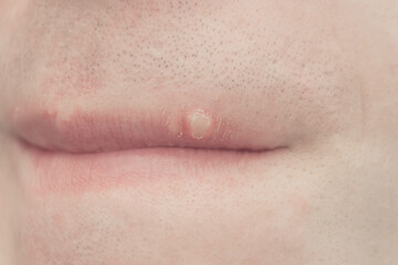 Obraz premium abscess on the face close-up. inflammation of the lip.