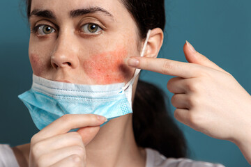 Rosacea. Close up portrait of a young woman shows redness on her cheeks from wearing a protective mask. Blue background. The concept of maskne and skin irritation - obrazy, fototapety, plakaty