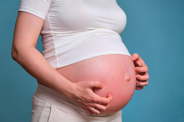 Pimples on the belly of a pregnant woman, studio shot on a blue background