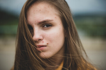 Portrait of young beautiful cute teenage girl woman with frackles and problematic skin on natural...