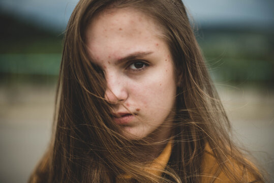 Portrait of young beautiful cute teenage girl woman with frackles and problematic skin on natural background. Girl power, body positive, real people.