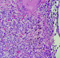 Photo of malignant melanoma at eyelid, showing tumor cells with some melanin pigments,...