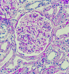 Photo of glomeruli with segmental endocapillary hypercellularity in patient with IgA nephropathy, magnification 400x, photo under microscope