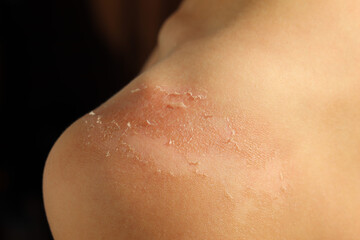 Peeling of the skin after sunburn on a person's shoulder, sunburn, close-up, epidermis