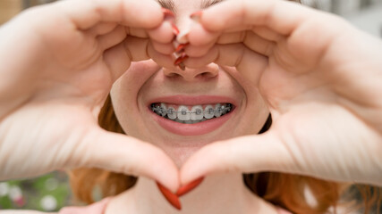 Close-up portrait of a young red-haired woman with braces on her teeth holding her hands in the shape of a heart. Orthodontic appliances for a perfect smile.