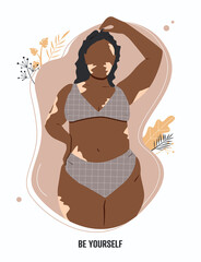 Be yourself card. Beautiful vitiligo woman, model. Flat vector illustration.
