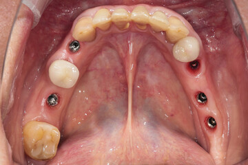 Obraz premium gum cavity with installed implants before installing crowns in the lower jaw