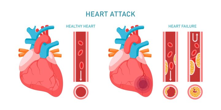 Heart attack and cardiovascular diseases infographic. Healhty and failure hearts, atherosclerosis symptoms and diagnosis. Flat vector illustration. Design for medicine, treatment, health care concept