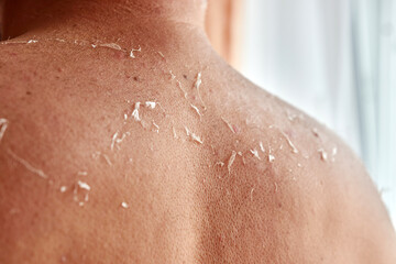 Sunburned skin comes off a man's back. Skin care during tanning. Sunburn.