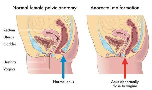 Medical illustration compares a normal female pelvic anatomy with one afflicted from anorectal malformation, with annotations. 