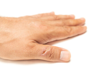 Male hand with a deep cut on the finger isolated on white background.