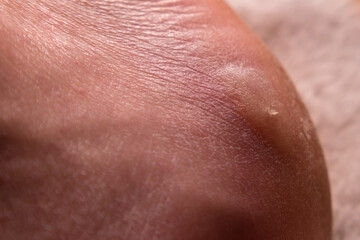 Close-up of a man's foot with a callus and dry skin.