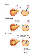 Insulin action and diabetes type 1 and 2, 2d 3d graphic, render