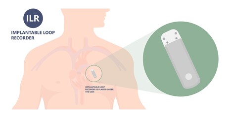 loop holter event atrial heart attack stroke ECG EKG device monitoring rhythm cardiac chest risk ILR Implantation ICD atrial rate beat pain artery pulse - obrazy, fototapety, plakaty