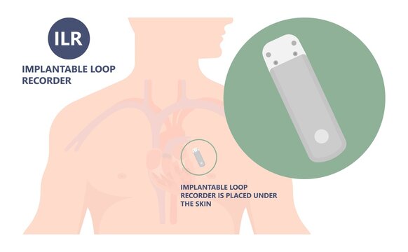 Loop Holter Event Atrial Heart Attack Stroke ECG EKG Device Monitoring Rhythm Cardiac Chest Risk ILR Implantation ICD Atrial Rate Beat Pain Artery Pulse