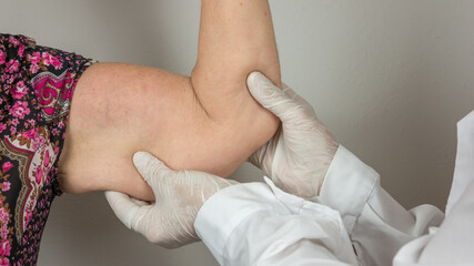 surgeon doing a medical check up by palpating the forearm, on adipose tissues, cellulite, on a...