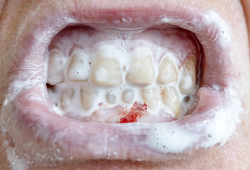 blood on the gums when brushing teeth with toothpaste. close-up