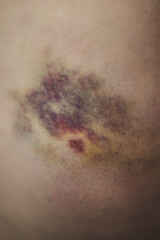 Trauma on a skin after an accident. Haematoma recovery process. Inner bleeding after impact on the...
