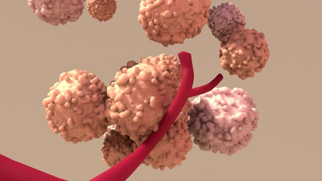 Tumor, abnormal mass of tissue that forms when cells grow and divide more than they should or do not die when they should. - Powered by Adobe