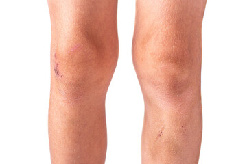 Scratches, bruises and abrasions on the boy's knees on a white isolated background.