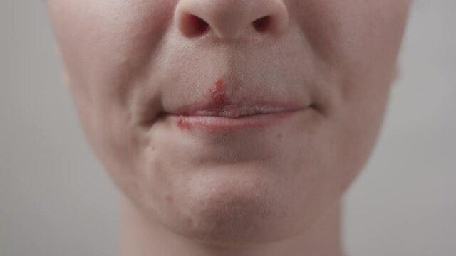 Closeup crop female licking and biting lips with herpes blisters