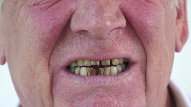 Smoker mouth with yellow stained Bad teeth of an old Caucasian man. smoker sick. curved teeth of a smoker covered with dental stone, macro close up. oral hygiene. help of specialist dentist. Tutorial.