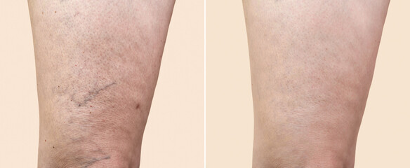 Part of a leg of a middle-aged woman with varicose veins and capillaries before and after medical...