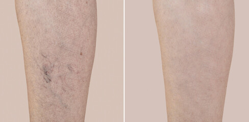 Part of a leg of a middle-aged woman with varicose veins and capillaries before and after medical treatment. Close-up.