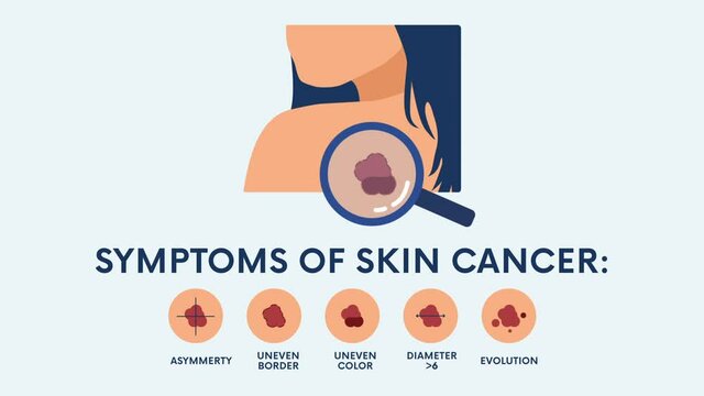 Skin cancer symptoms 2D animation on transparent background. Melanoma concept. Can be used for topics like oncology, tumor, awareness, healthcare