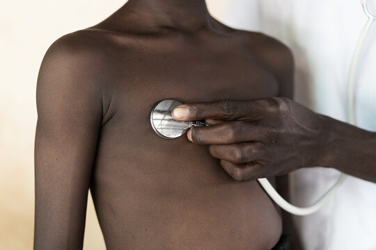 Close-up of a pediatric pneumologist auscultating the lungs and heart of a small African child with respiratory problems