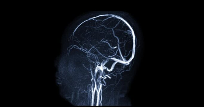MRV Brain or magnetic resonance venography of The Brain turn around on the screen for abnormalities in venous drainage of the brain.