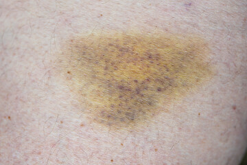 Bruise on wounded man leg skin, closeup