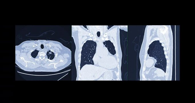 Compare of CT Chest or CT Scan of  Lung Axial ,Coronal and sagittal MIP View for diagnosis TB,tuberculosis and coronavirus or covid-19 .