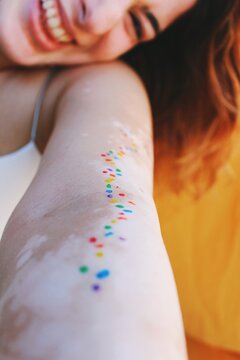 Closeup image of arm & smiling face of young woman with skin condition vitiligo , colors of paint around spots
