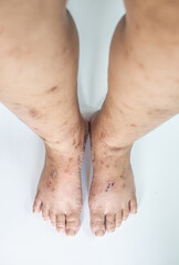 Scar from allergy symptom on the skin of the leg