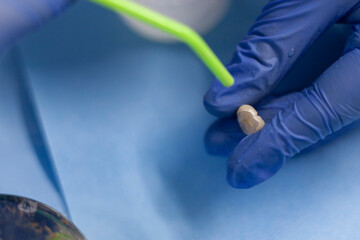Measuring specialist repairs tooth by placing a new crown