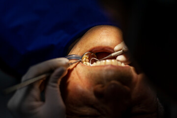 Close up dental examination and treatment, dental cleaning, dental instrument, hygienic dental