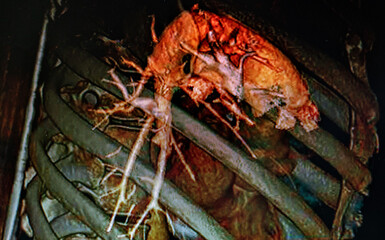 CAT Scan image pulmonary angiography. Medical themes.