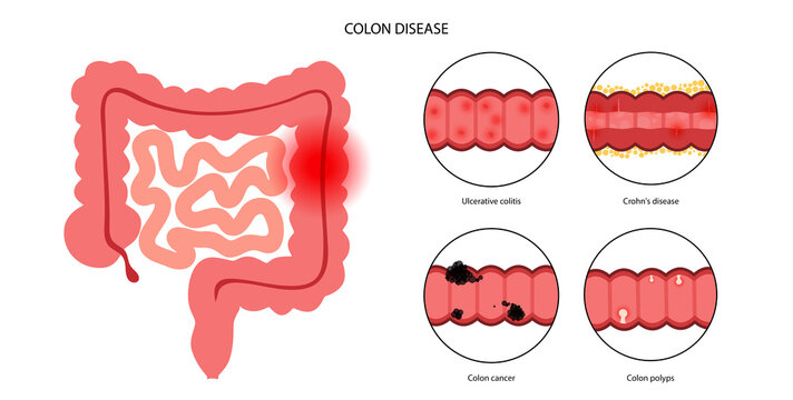 Intestines diseases concept