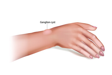 Ganglion Cyst of the Wrist and Hand. Synovial cyst or a Gideon s Disease, or a Bible Cyst, or a Bible Bump. - obrazy, fototapety, plakaty