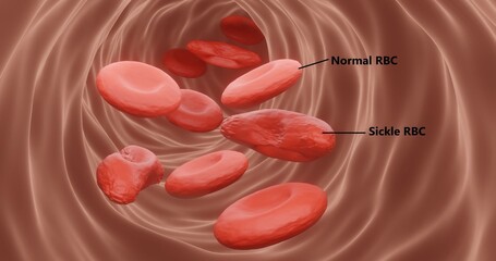Sickle cell anemia in 3d illustration