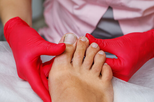 Onycholysis of toenails in a man. Healing male pedicure. The orthopedic surgeon examines the problem foot.