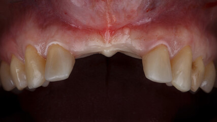 Obraz premium oral cavity without two teeth of the upper jaw on a black background