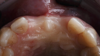 The cavity of the gums in occlusion without two central teeth before implantation