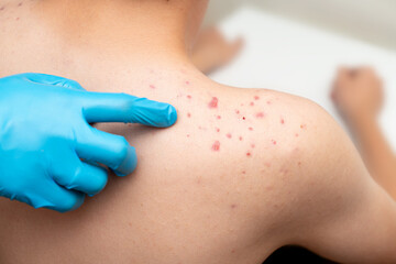 Teenage acne-acne on the shoulder of a young man at a doctor's appointment in a clinic for the treatment of a problem.