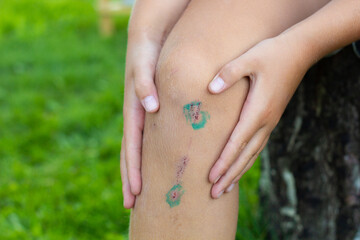 Abrasion on a child's leg, treated with brilliant greens. Small wound. Close-up. Place for your text.
